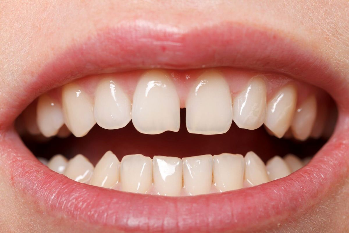 دلیل فاصله میان دندان‌ها چیست؟