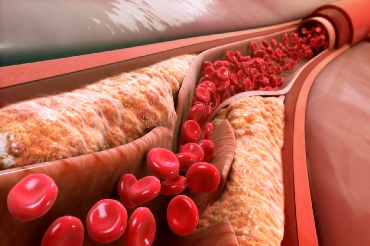 شش علامت که نشان دهنده سطح بالای کلسترول خون است