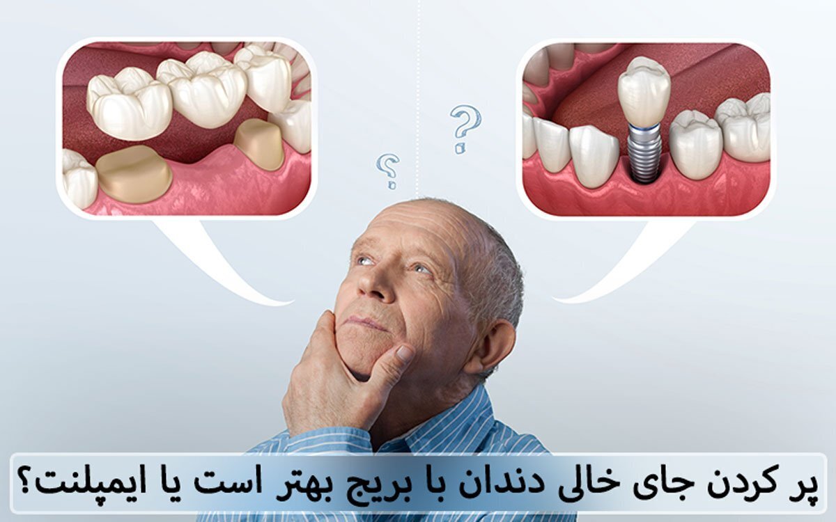 پل دندان بهتر است یا ایمپلنت؛ کدام روش مقرون به صرفه تر است؟