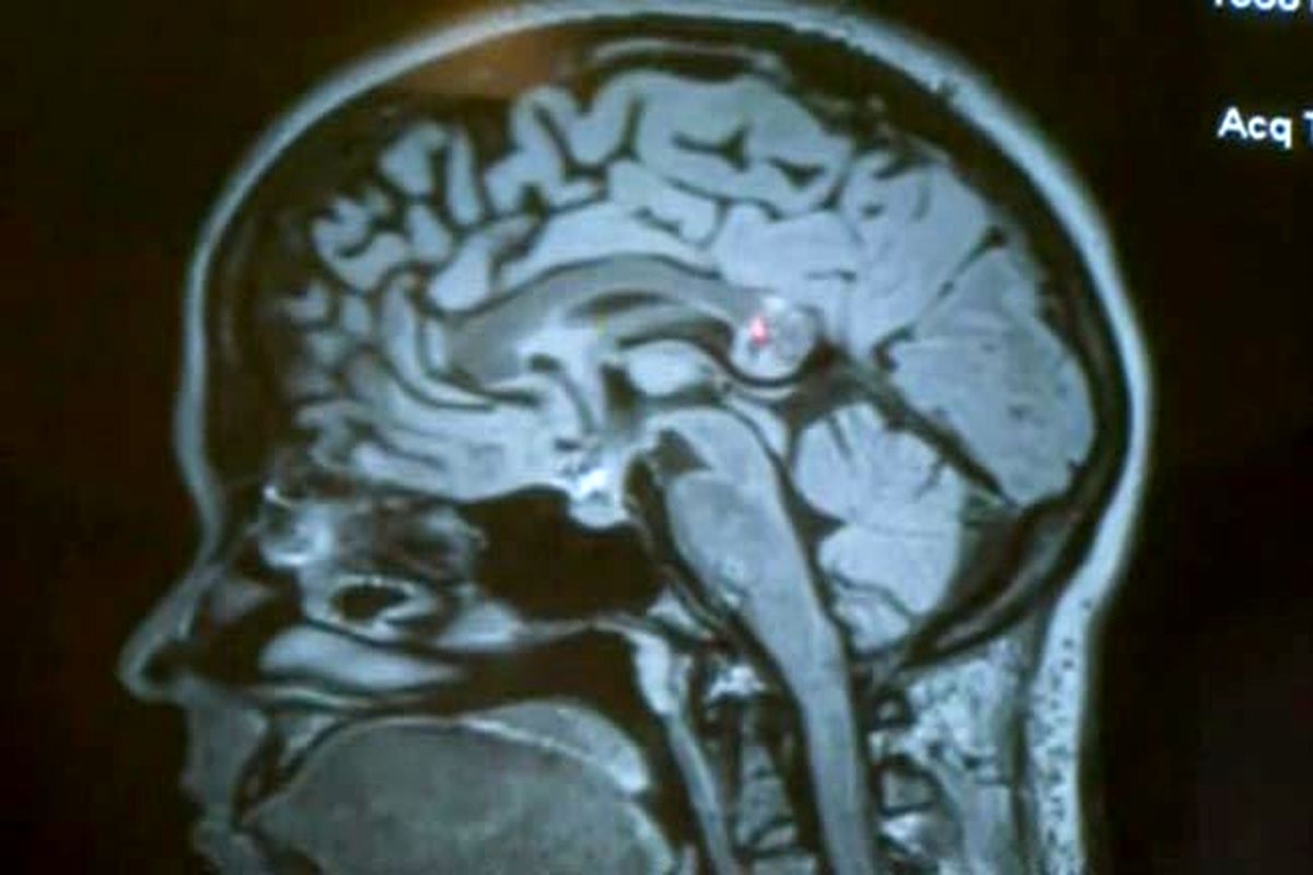 جنین از مغز یک زن خارج شد!+فیلم