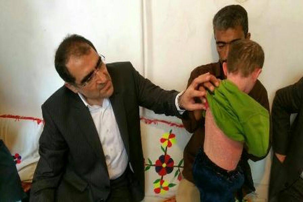 عیادت وزیر بهداشت از کودک بیمار بروجردی