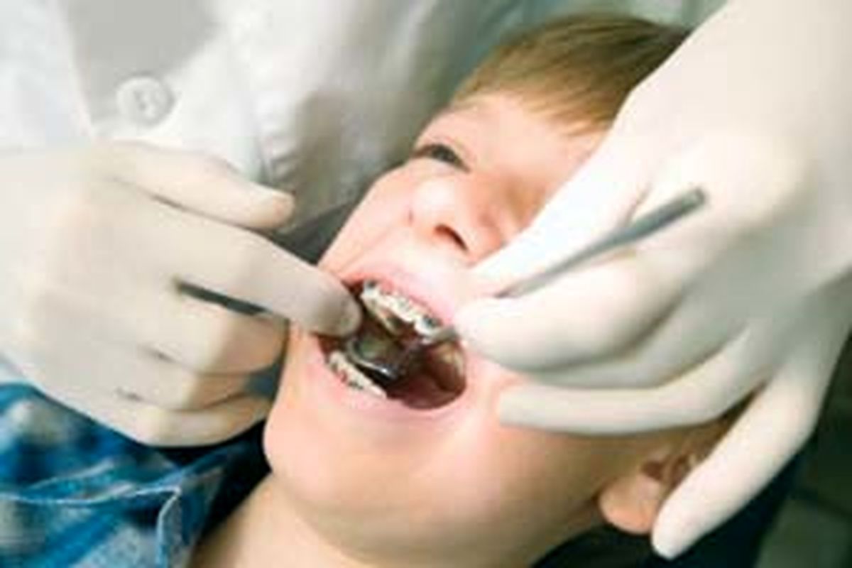 کودکان تهرانی بالاترین آمارپوسیدگی دندان رادارند