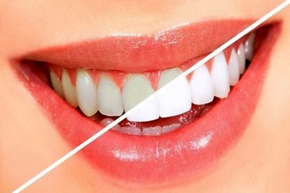 طبیعی ترین راهکار برای سفید کردن دندان ها در خانه