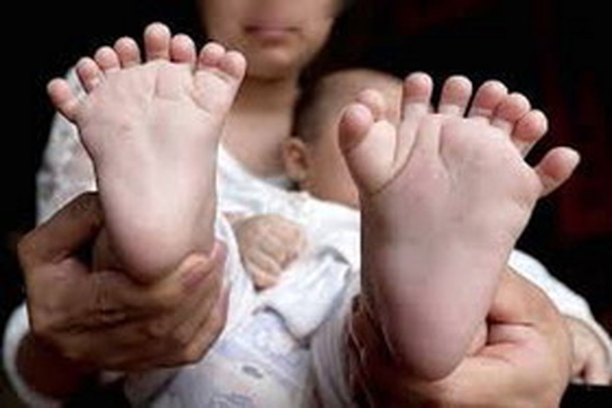درخواست کمک مالی والدین نوزاد ۳۱ انگشتی