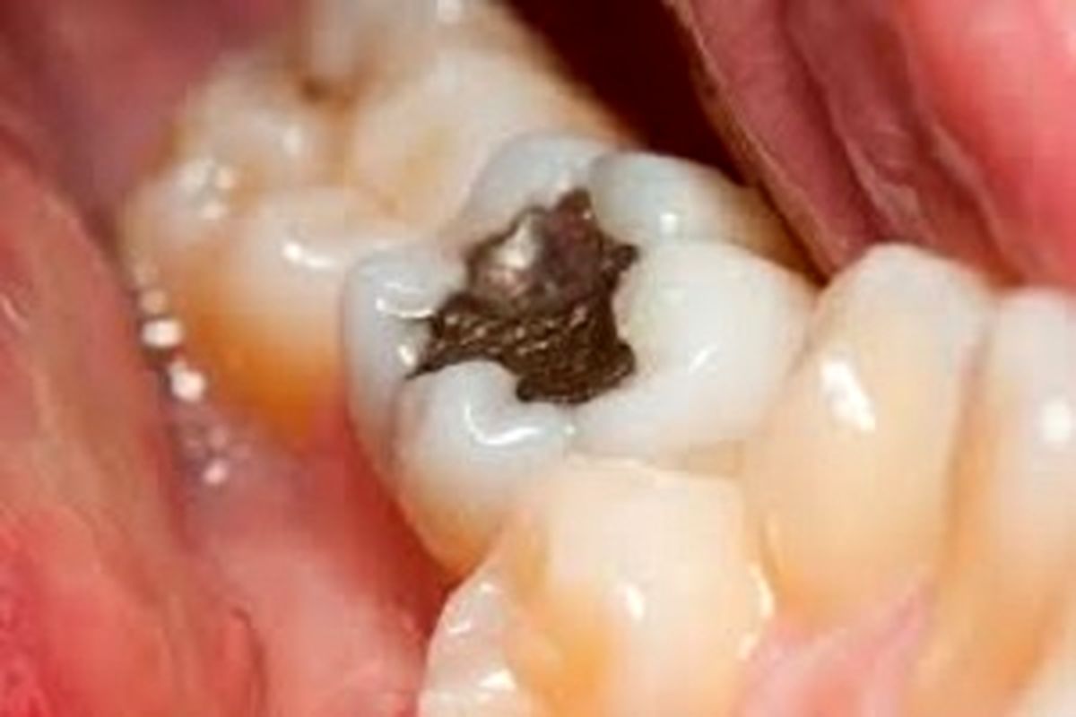 مشکل پوسیدگی دندان را در خانه حل کنید