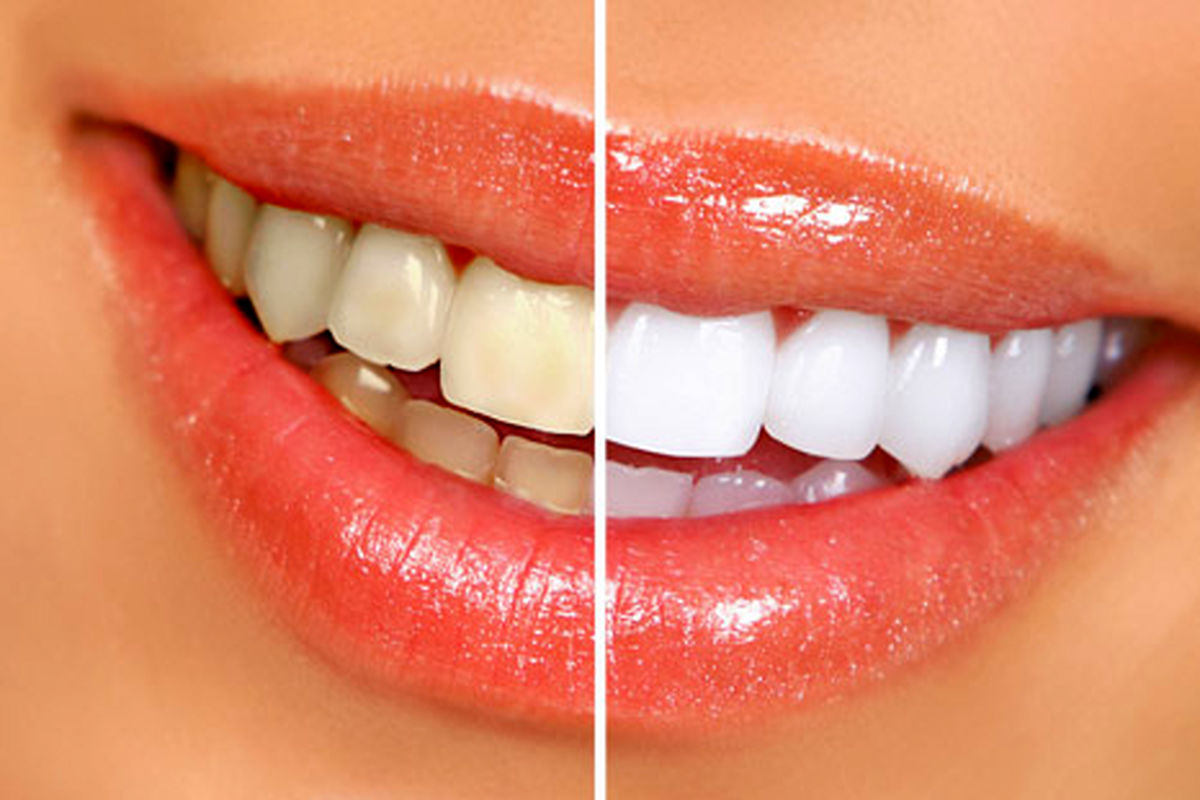چند راهکار ساده برای داشتن دندان های سفید