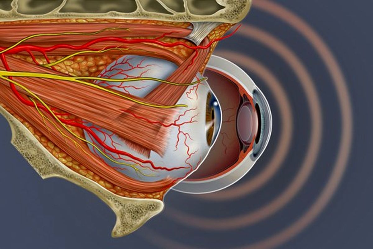 سکته چشم را بشناسید