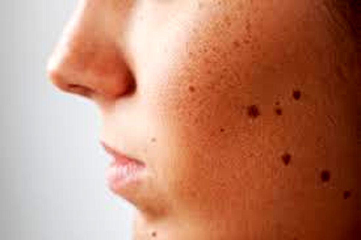 چهار علامت تبدیل خال به سرطان / آنچه درباره کرم‌های ضدآفتاب باید بدانید