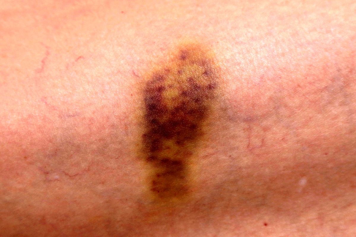 علت کبودی بدن خود را بدانید