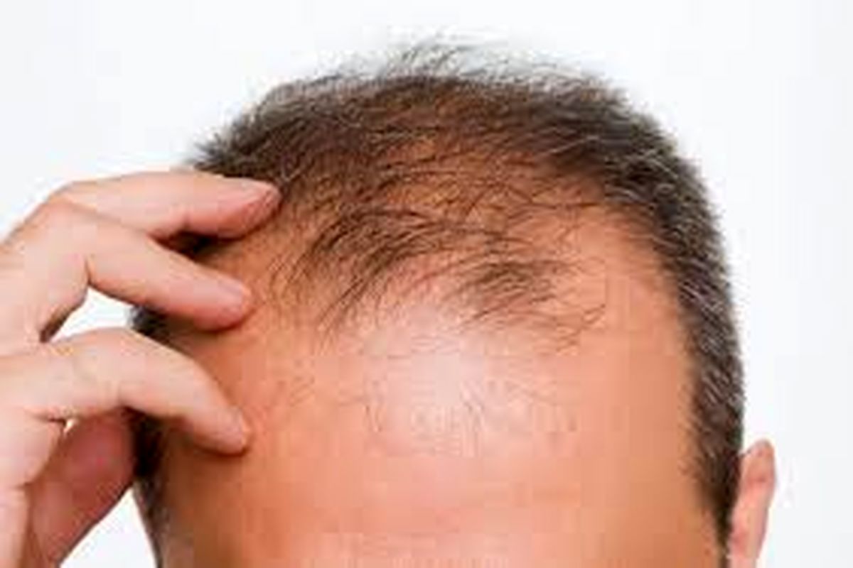 با این راهکارها از ریزش موی سر خود جلوگیری کنید