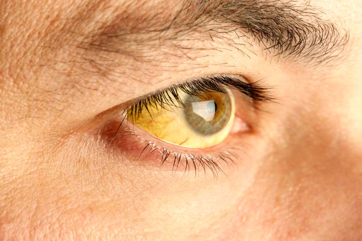 آیا زردی چشم به معنای هپاتیت است؟