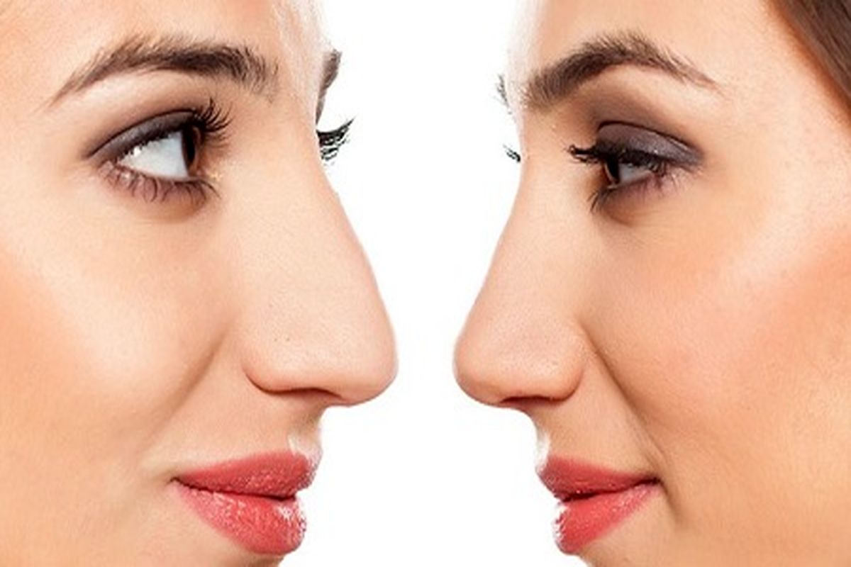 چگونگی کوچک کردن بینی بدون جراحی؟