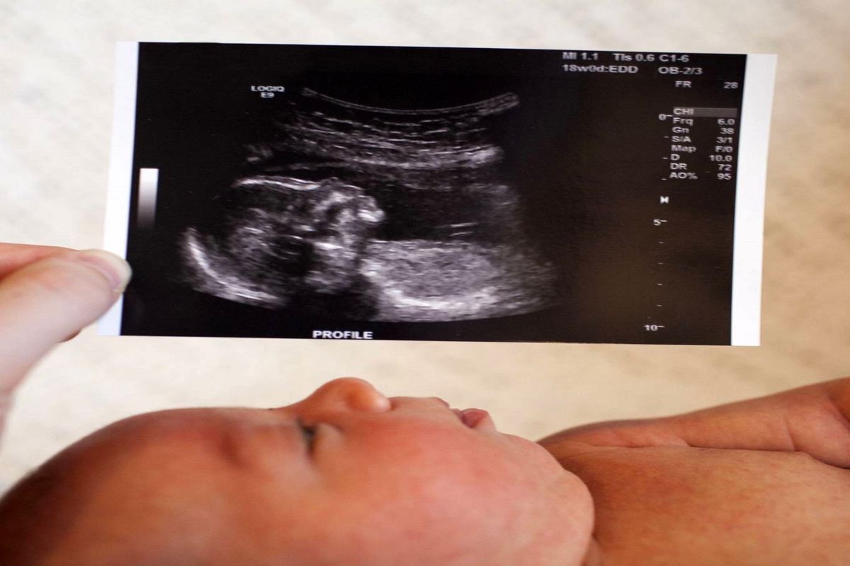 حذف غربالگری چه بلای بر سر جمعیت ایران می‌آورد؟