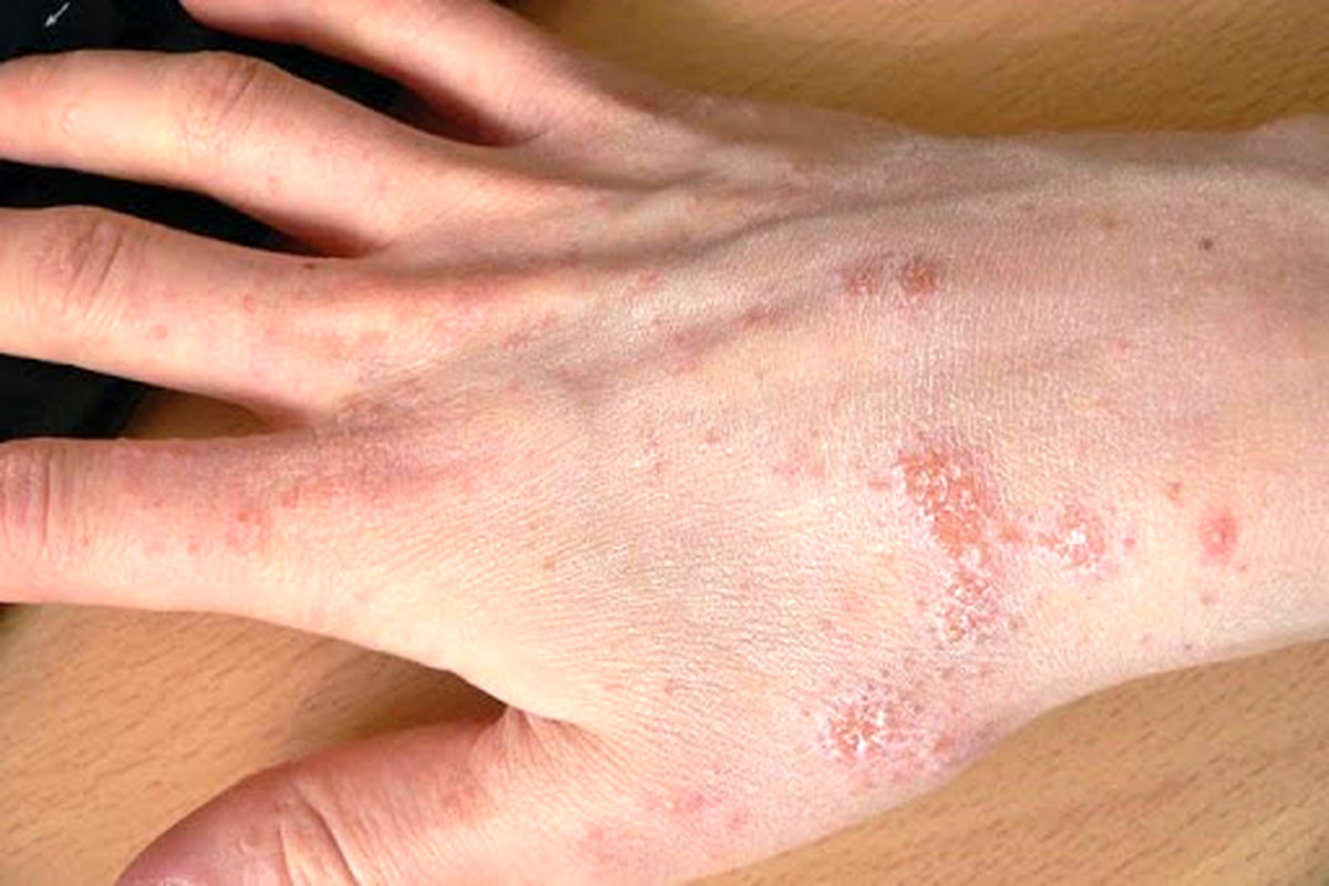 پنج عارضه پوستی مرتبط با کووید-۱۹