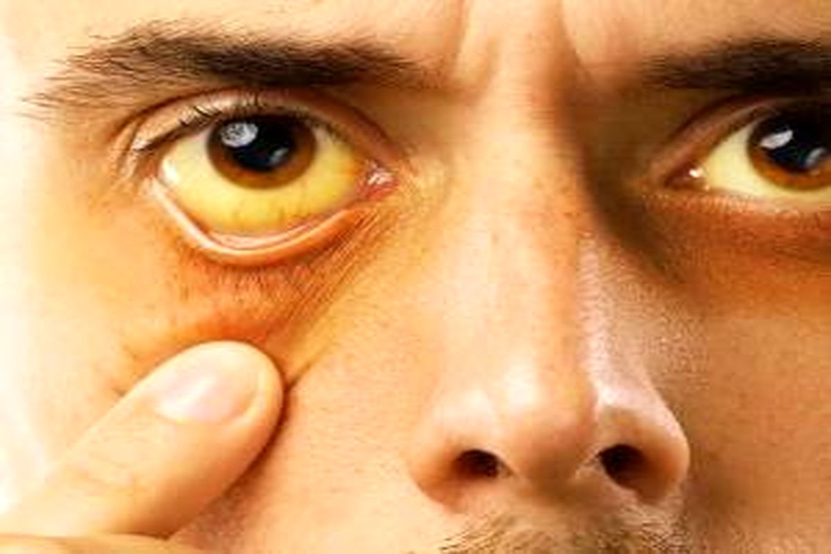 چه زمانی زردی چشم خطرناک می شود؟