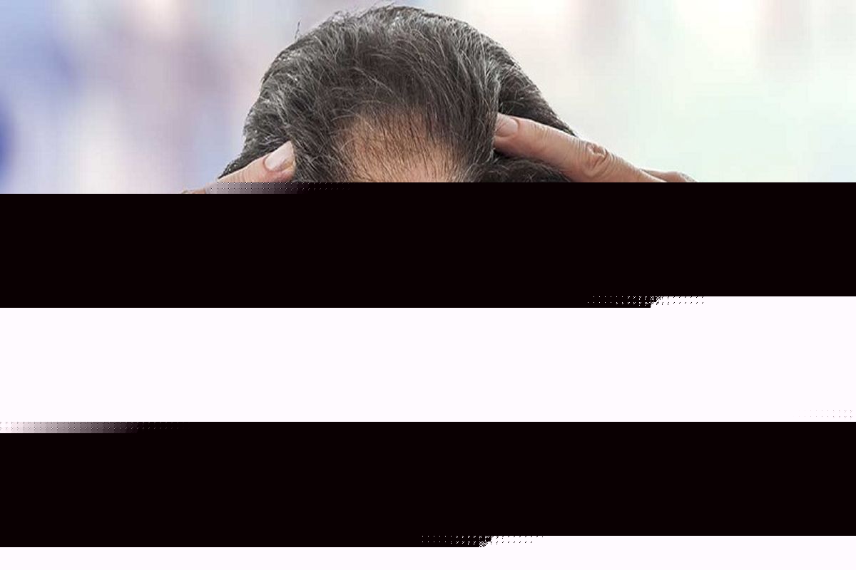 آیا استرس کرونا باعث ریزش مو می شود؟