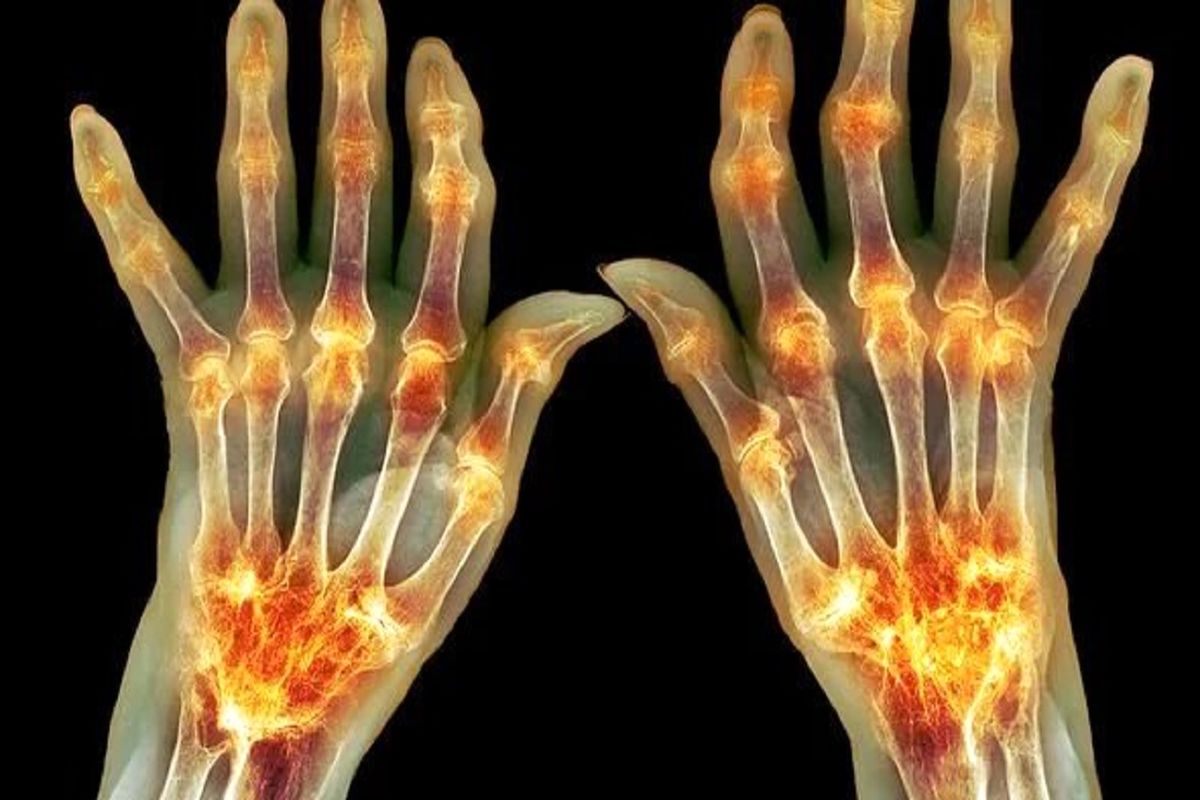 چند میوه برای تسکین علایم التهاب مفصل