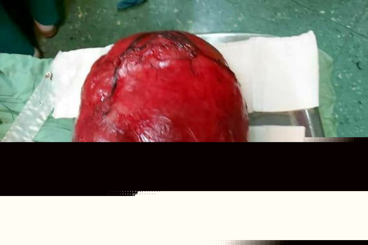 خارج کردن دو توده‌ به وزن ۱۲ کیلو از شکم زن نهاوندی