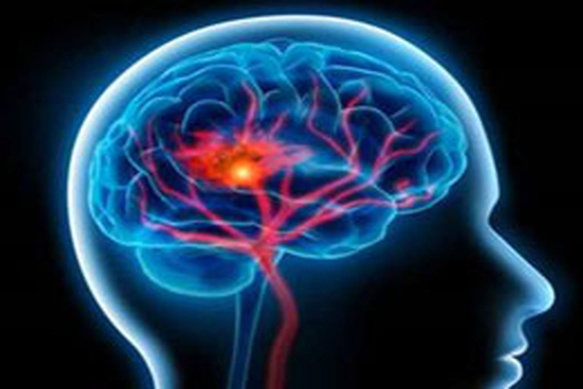 احتمال مرگ ۳ برابری بر اثر سکته مغزی در کرونایی‌ها