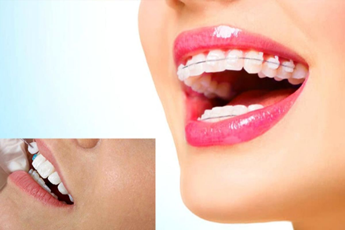 برای مرتب کردن دندان ها لمینت بهتر است یا ارتودنسی نامرئی؟