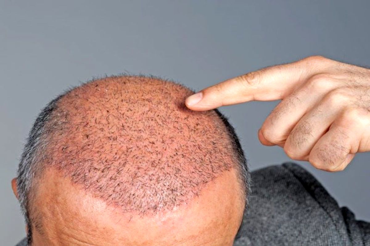 موثرترین روش کاشت مو در دنیا سال ۲۰۲۲