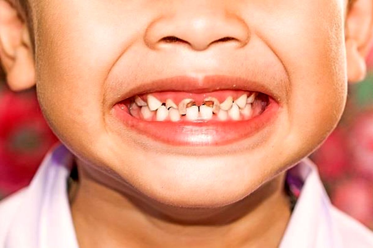 روش های جلوگیری از پوسیدگی دندان