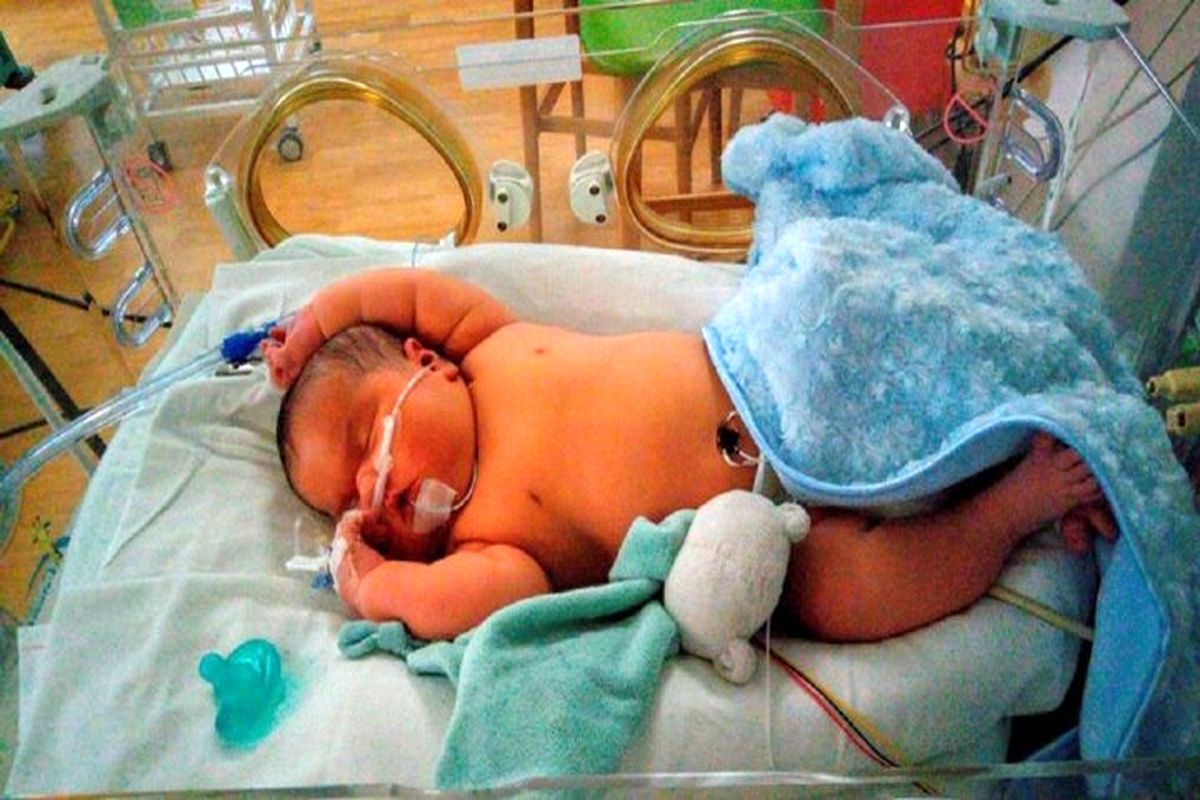 تولد یک نوزاد عجیب و غریب دارای دم در برزیل