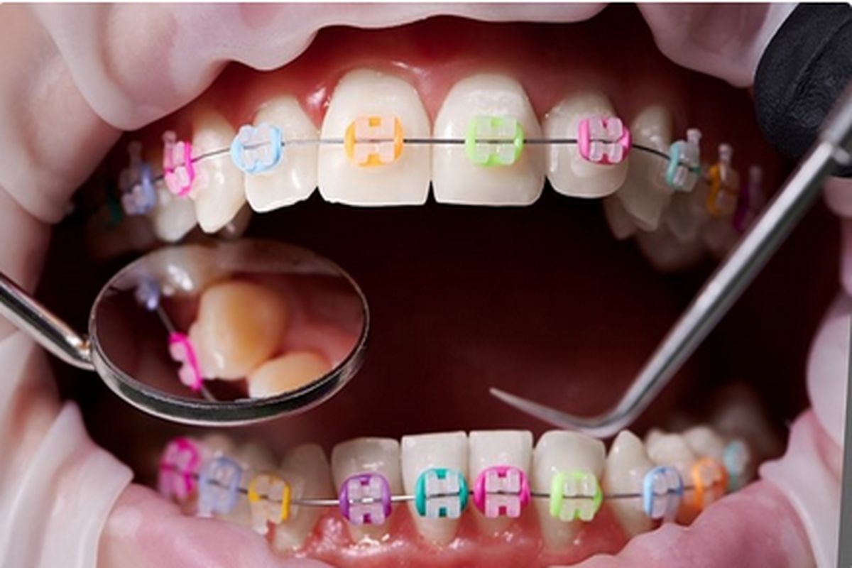 ارتودنسی دندان و مراقبت از براکت‌ها در حین آن