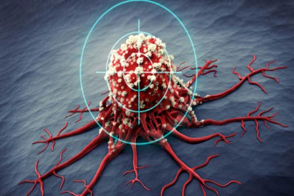 معرفی یک مدل تشخیصی بالقوه برای تشخیص زود هنگام سرطان سینه