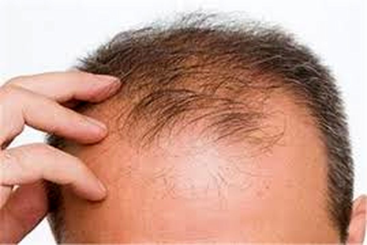 ۵ روش برای جلوگیری عملی از ریزش مو!