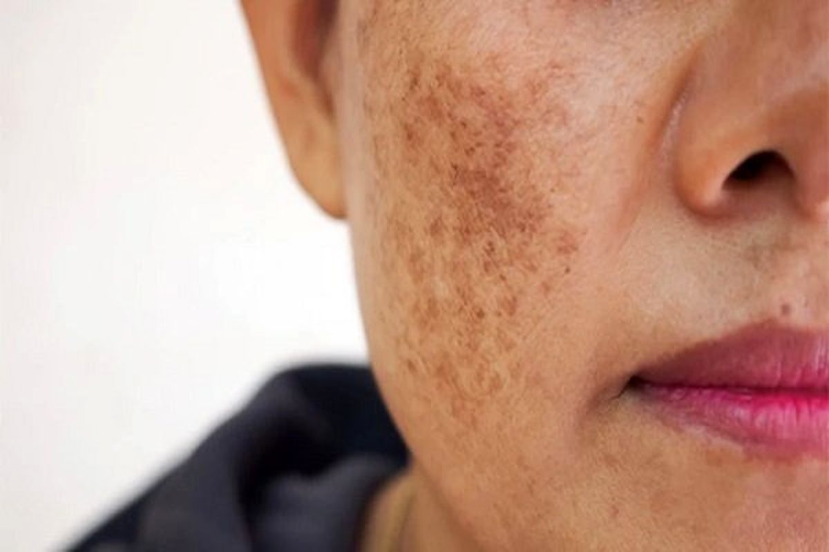 لکه های پوستی نشان دهنده بروز این بیماری است