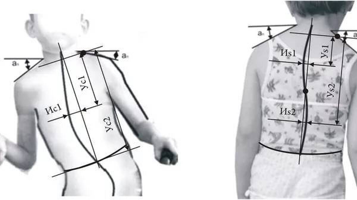 ساخت لباس مخصوص کودکان فلج مغزی