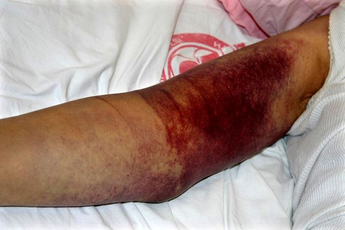 فوت یک بیمار مبتلا به تب "کریمه کنگو" در فارس