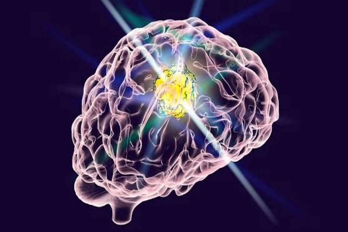 با نانوذرات سیلیس اثربخشی داروی ضد سرطان مغز افزایش یافت