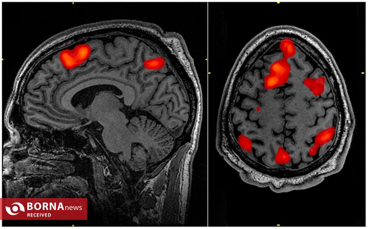 انقلابی در علوم اعصاب؛ تصویربرداری مغزی با فناوری نور مادون قرمز!