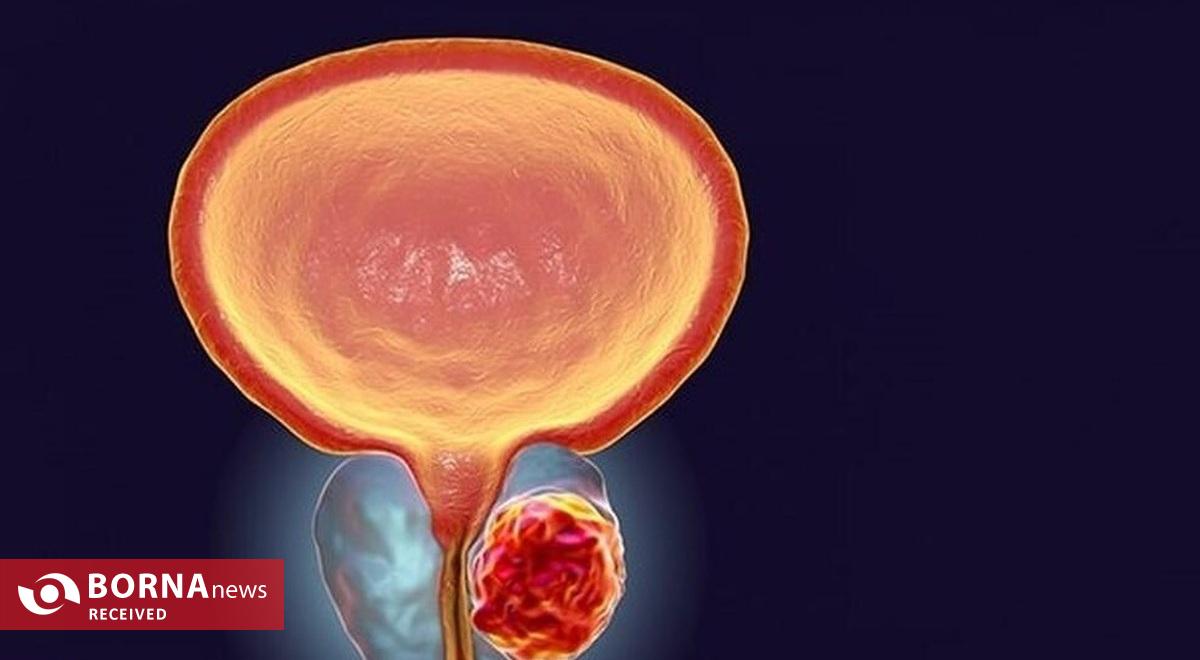 تشخیص سرطان پروستات با هوش‌مصنوعی ایرانی