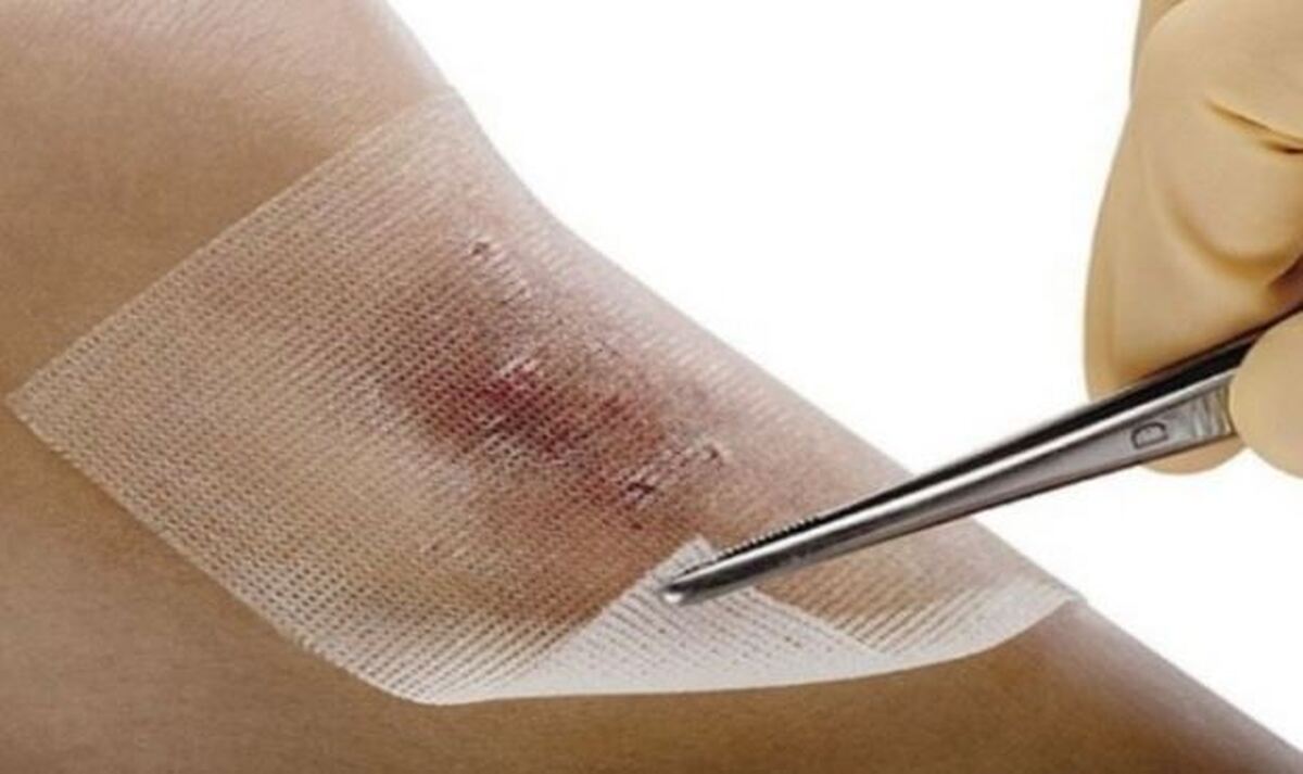 تولید زخم پوش های دولایه برای ترمیم زخم‌های مزمن