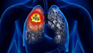علت ۸۵ درصد سرطان‌های ریه مشخص شد