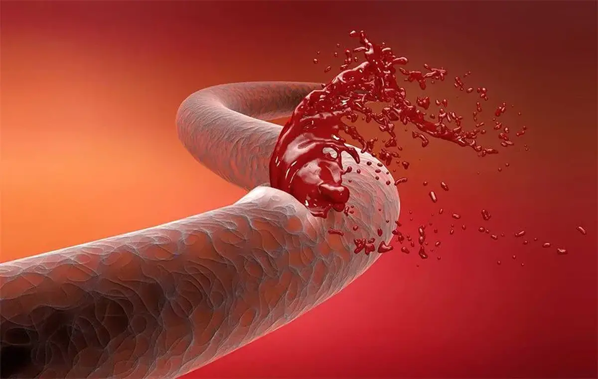 توقف یک ثانیه‌ای خونریزی ممکن شد