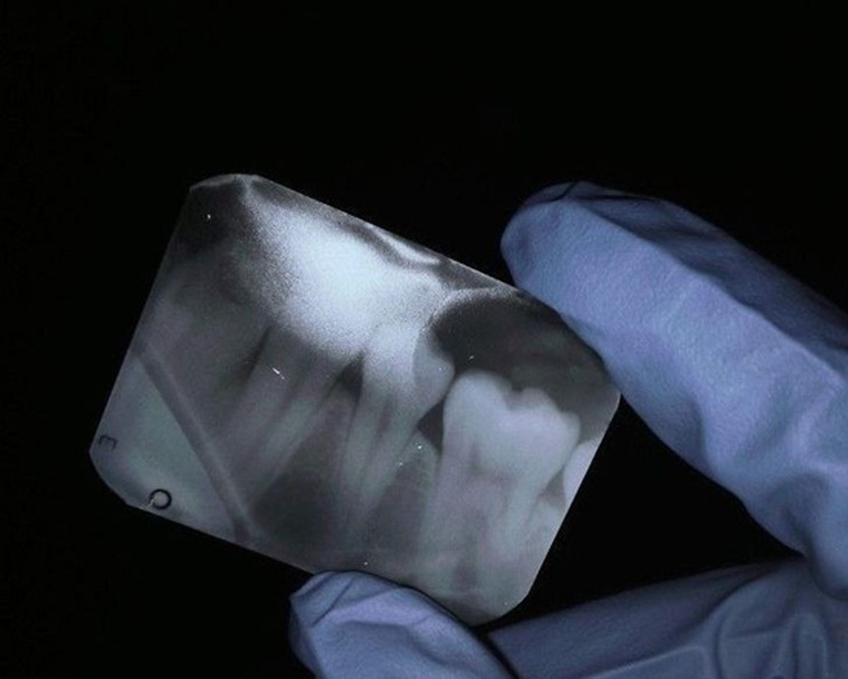 حساسیت دندان: علت‌ها، پیشگیری و درمان