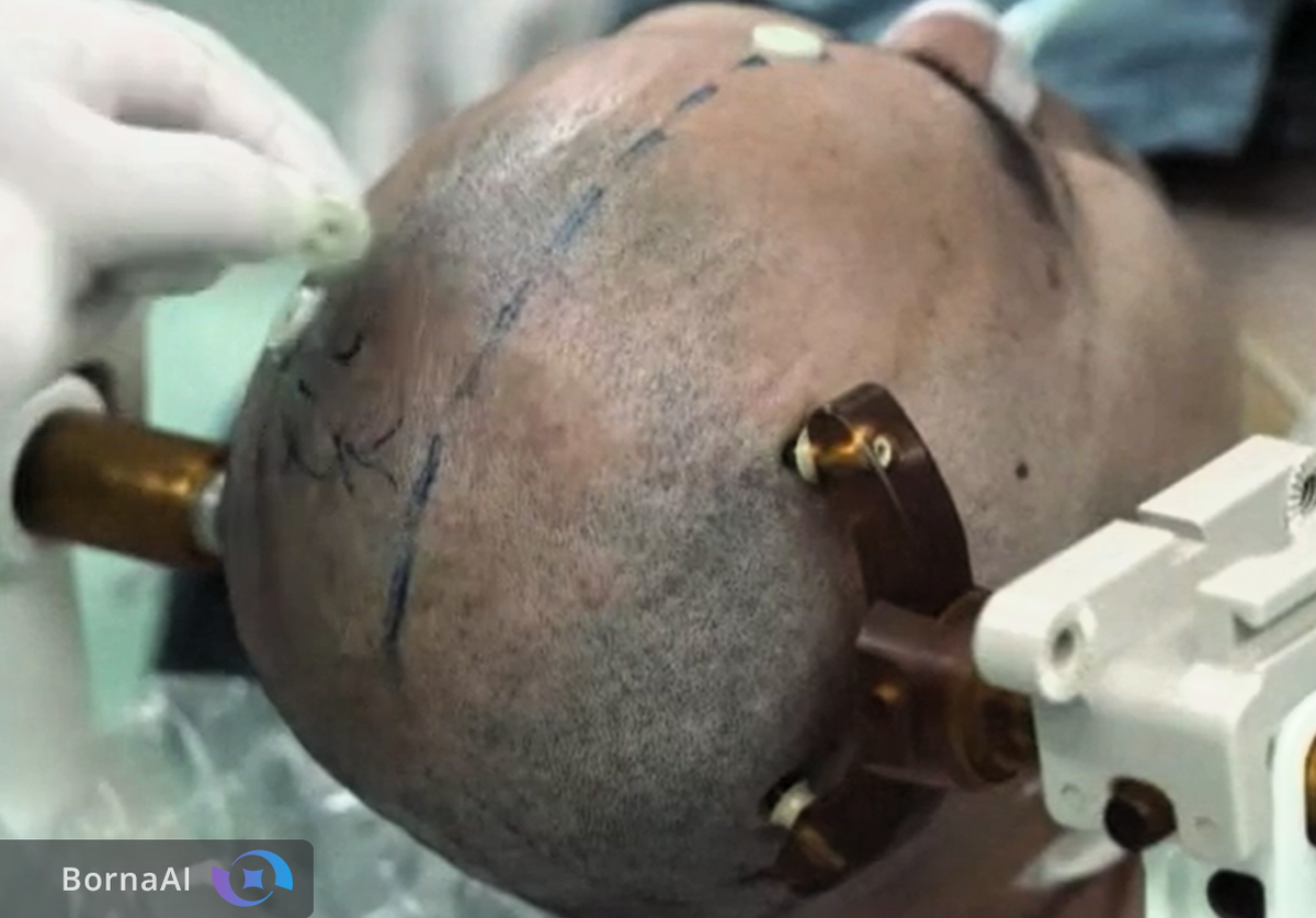 چین با تراشه مغزی ذهن را به ماشین متصل کرد