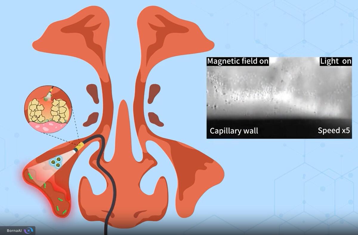 سینوزیت با ربات‌های نانویی درمان می‌شود!