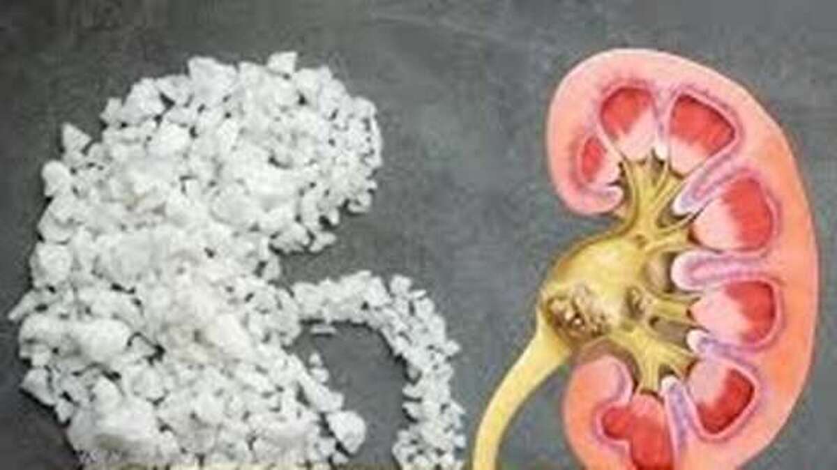 افزایش آگاهی، کاهش درد؛ توصیه‌های علمی درباره سنگ کلیه از زبان متخصص