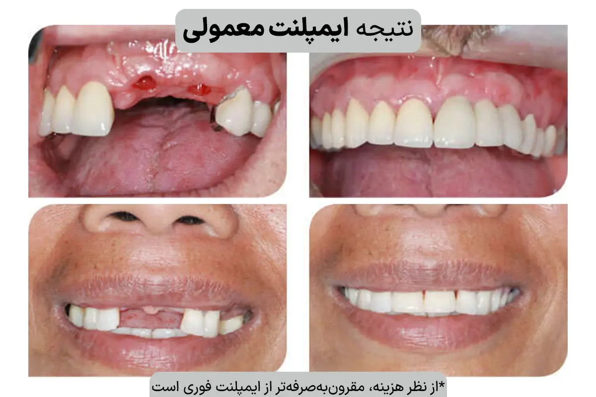 فرق ایمپلنت فوری و معمولی؛ حقایقی که دندانپزشکان کمتر درباره‌‌ شان حرف میزنند