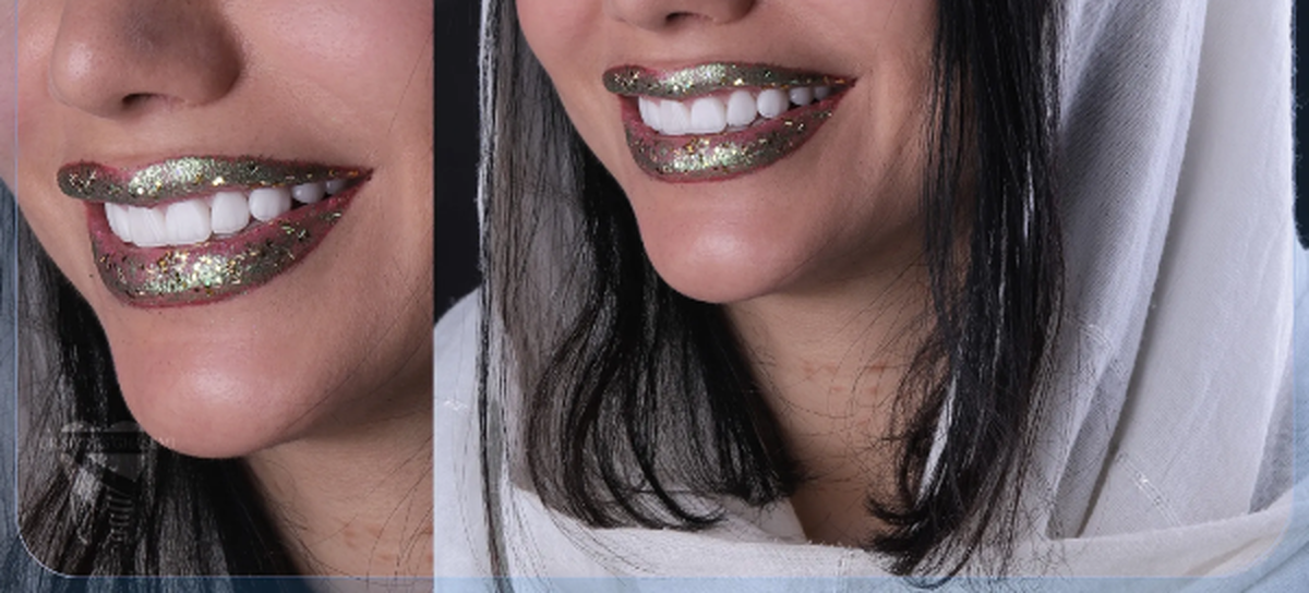 ایا میتوان همه دندان ها را با هم لمینت و ایمپلنت کرد؟