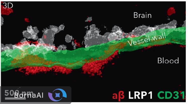 درمان آلزایمر با نانوذرات پلاک‌های مغزی را در چند ساعت پاک کرد!