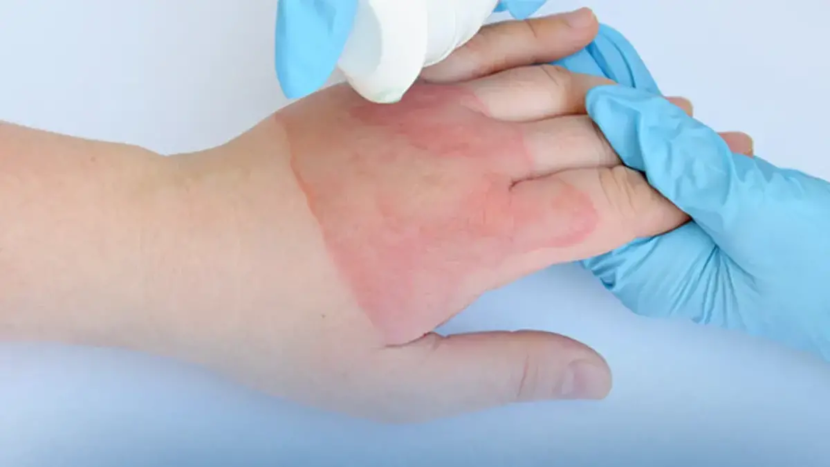 برگزاری وبینار فرهنگی آموزشی به مناسبت هفته جهانی سوختگی