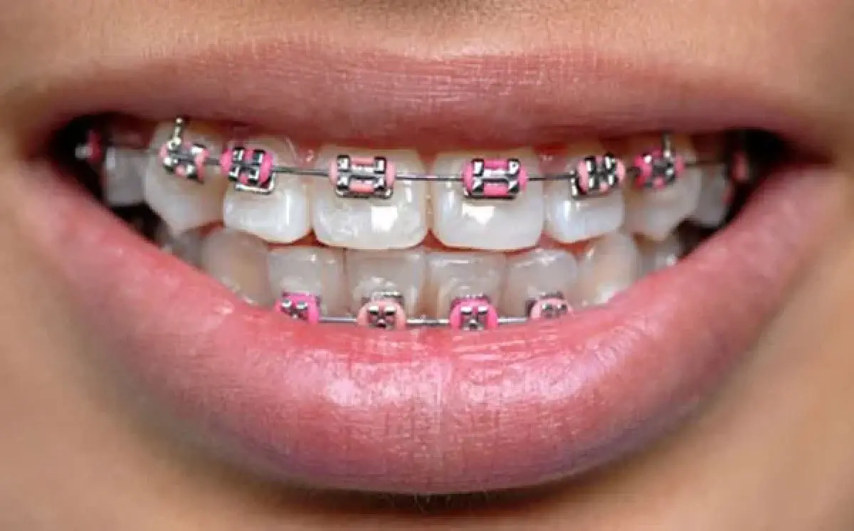 ارتودنسی چیست؟ هر آنچه درباره مرتب سازی دندان‌ها باید بدانید