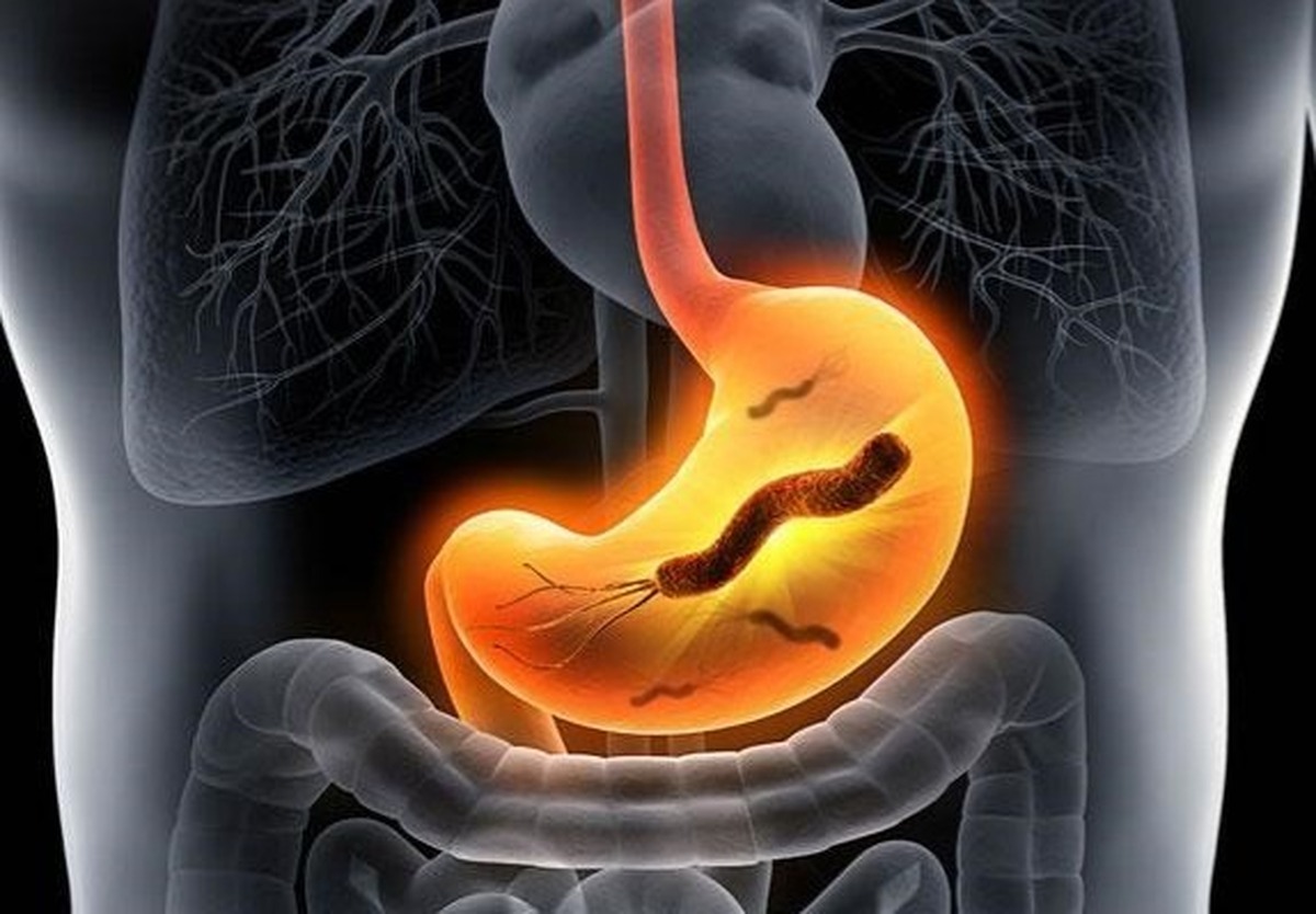 هلیکوباکتر پیلوری یا اچ پیلوری معده چیست؟